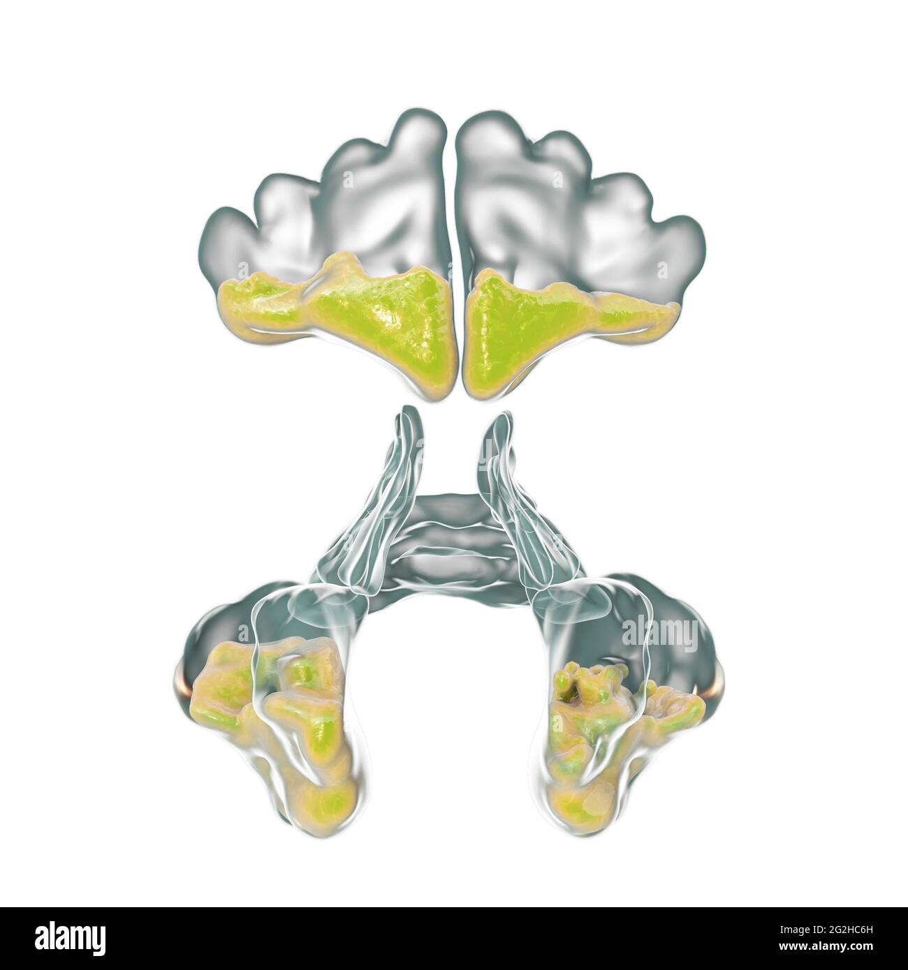 Sinusitis, Abbildung Stockfoto