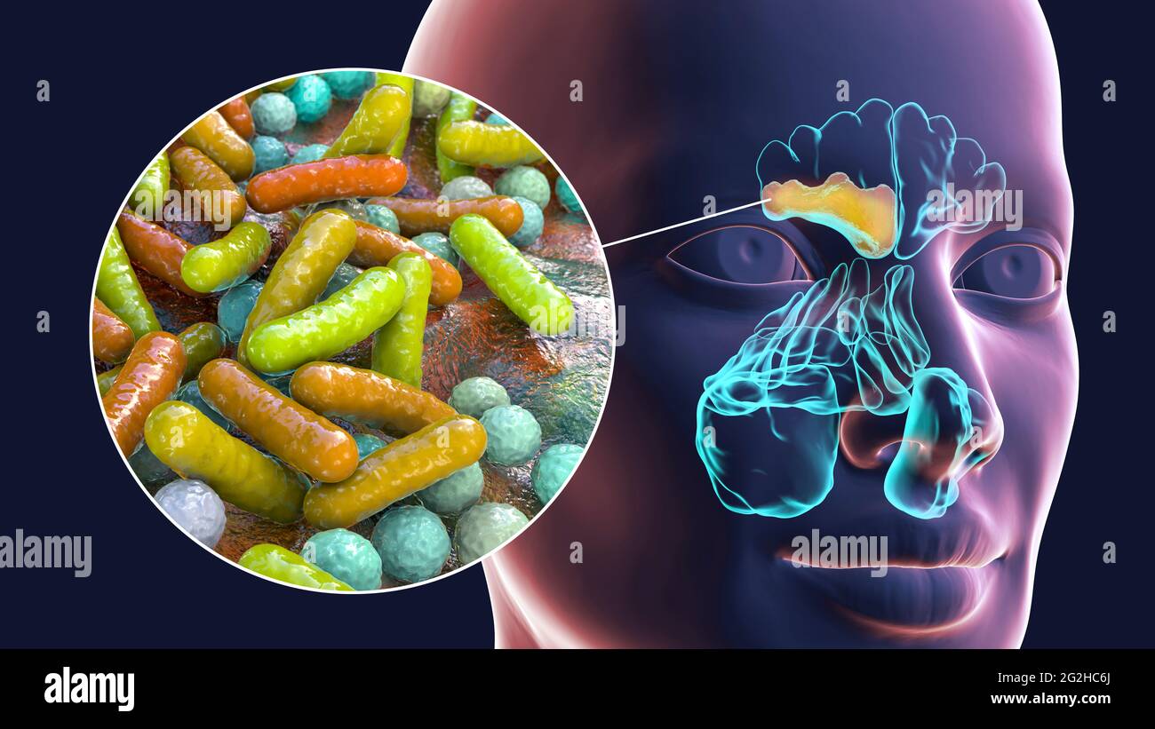 Sinusitis, Abbildung Stockfoto
