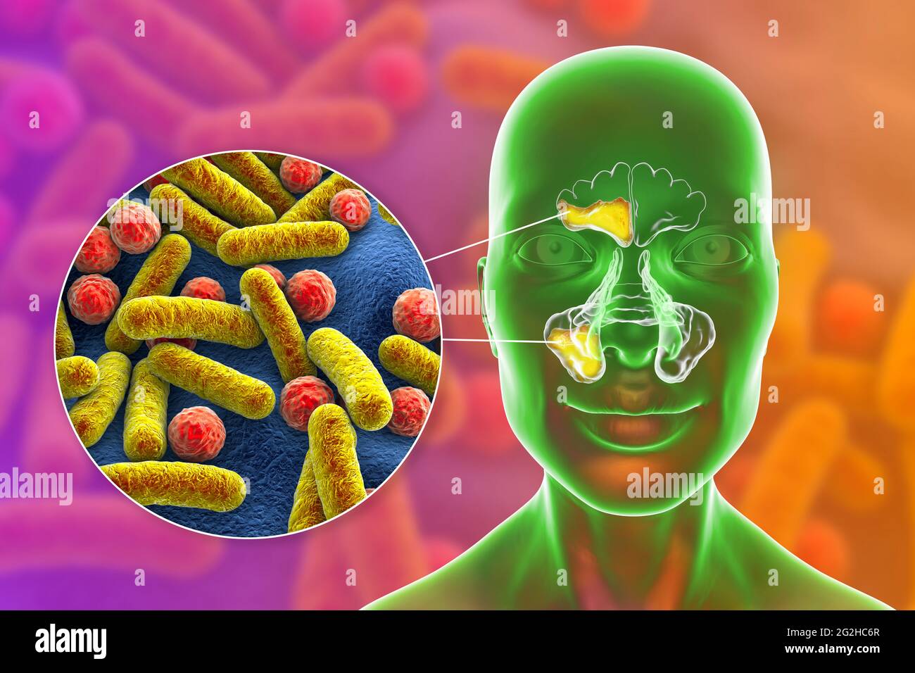 Sinusitis, Abbildung Stockfoto