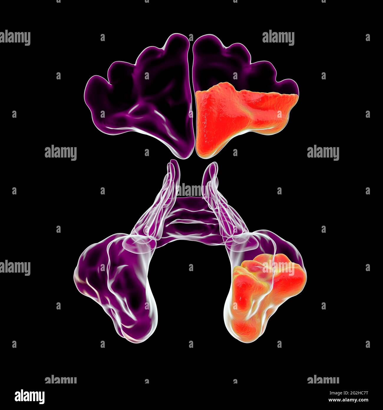 Sinusitis, Abbildung Stockfoto