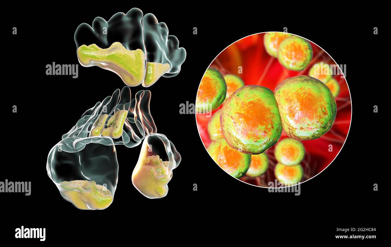 Sinusitis, Abbildung Stockfoto
