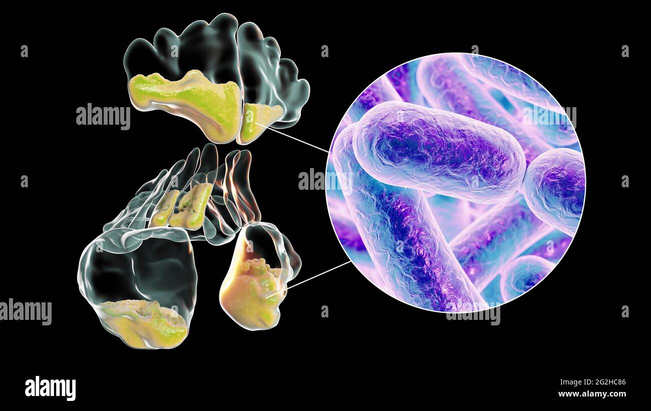 Sinusitis, Abbildung Stockfoto