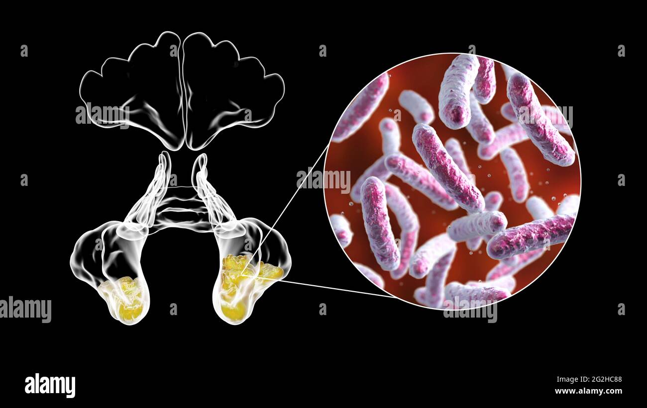 Sinusitis, Abbildung Stockfoto