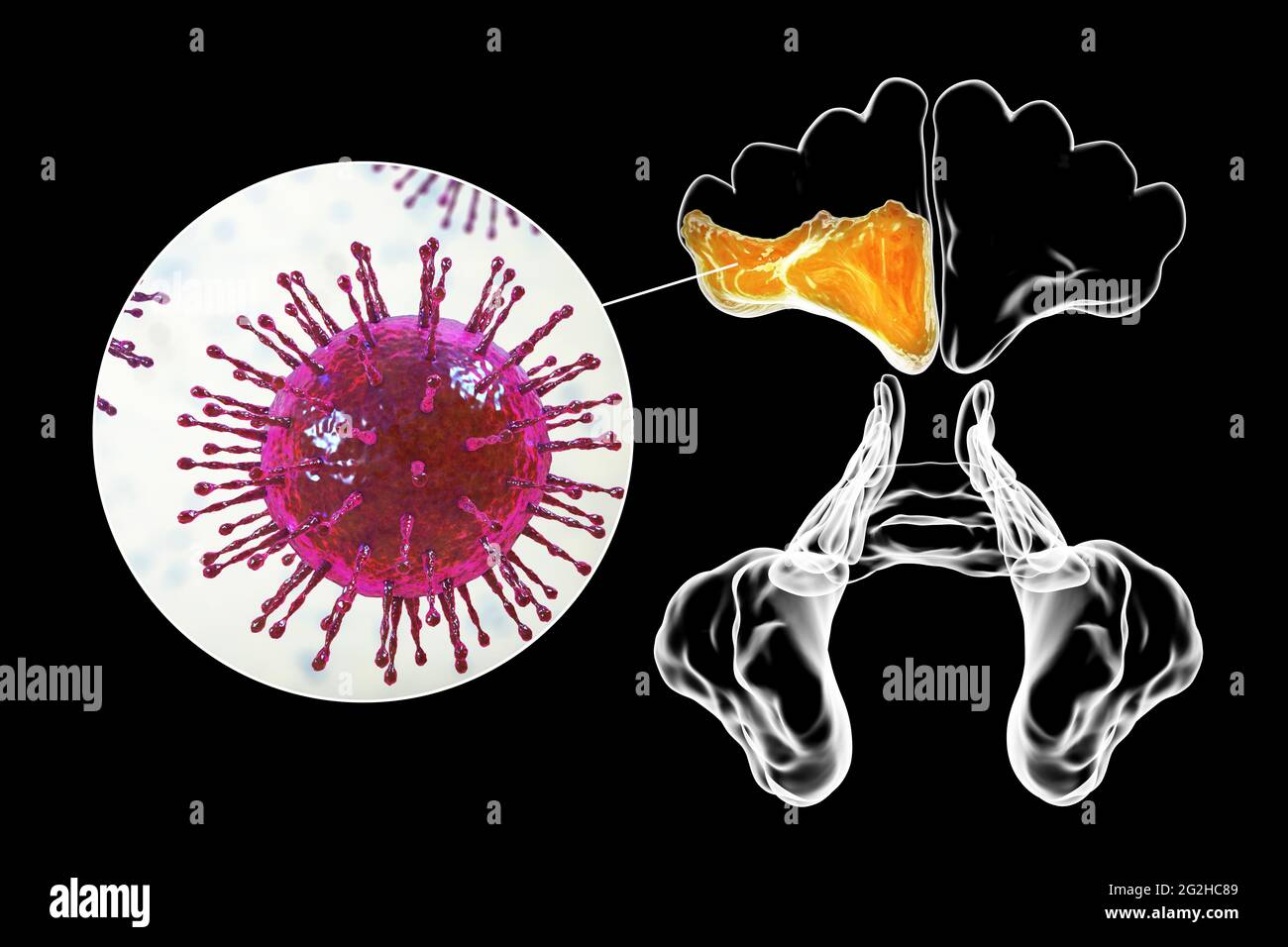 Sinusitis, Abbildung Stockfoto