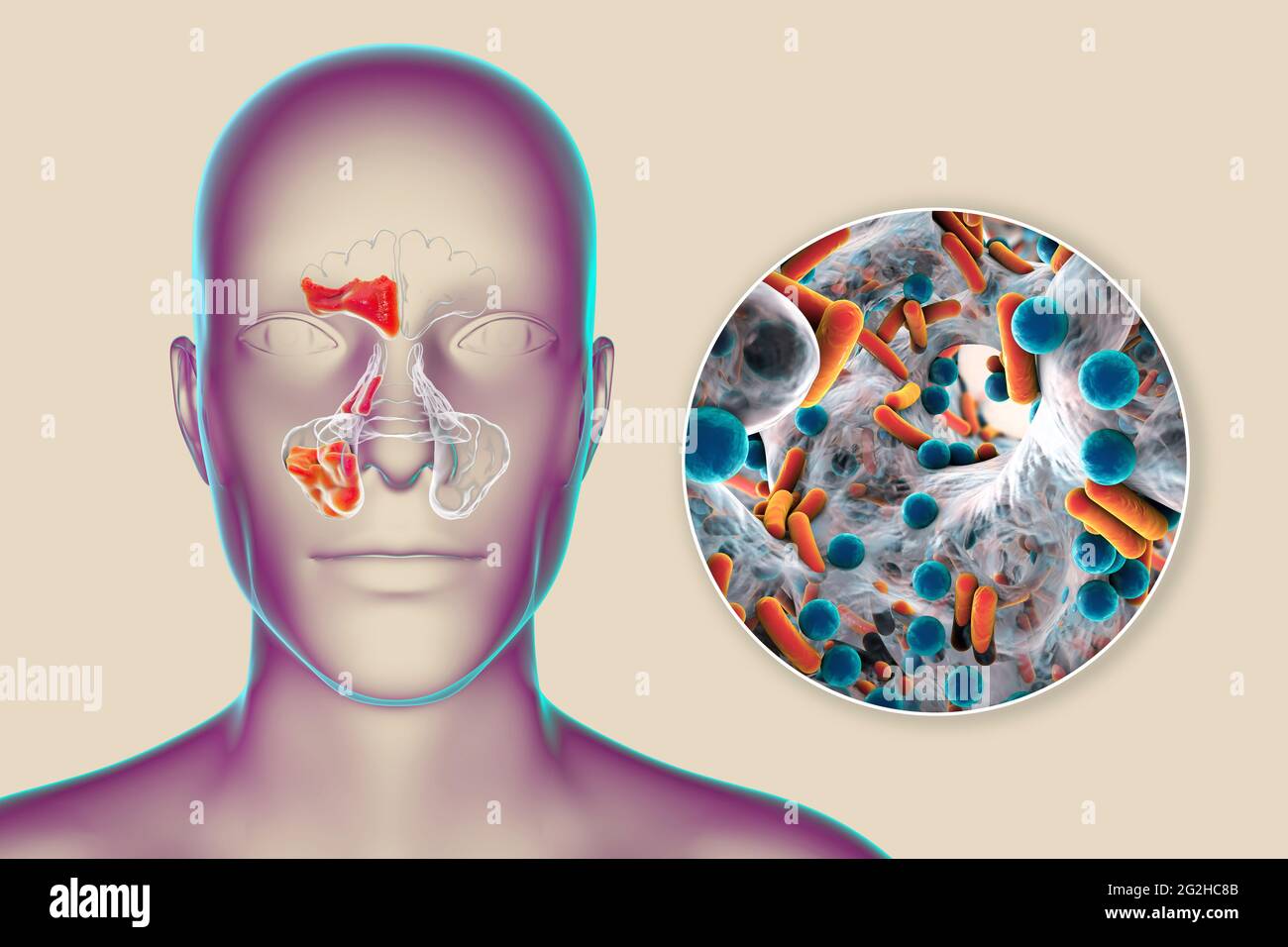 Sinusitis, Abbildung Stockfoto