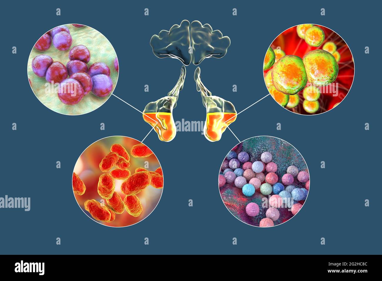 Sinusitis, Abbildung Stockfoto