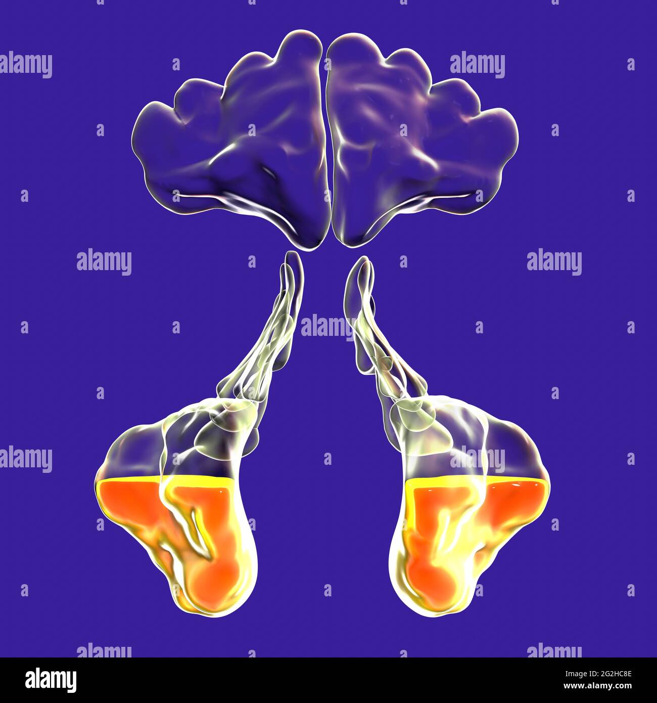 Sinusitis, Abbildung Stockfoto