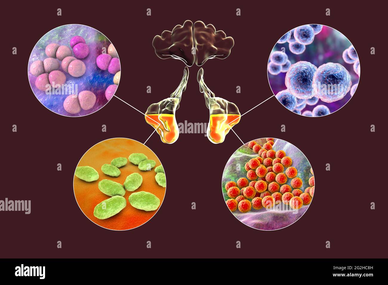 Sinusitis, Abbildung Stockfoto