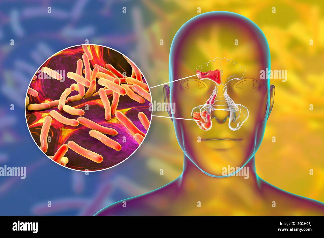 Sinusitis, Abbildung Stockfoto