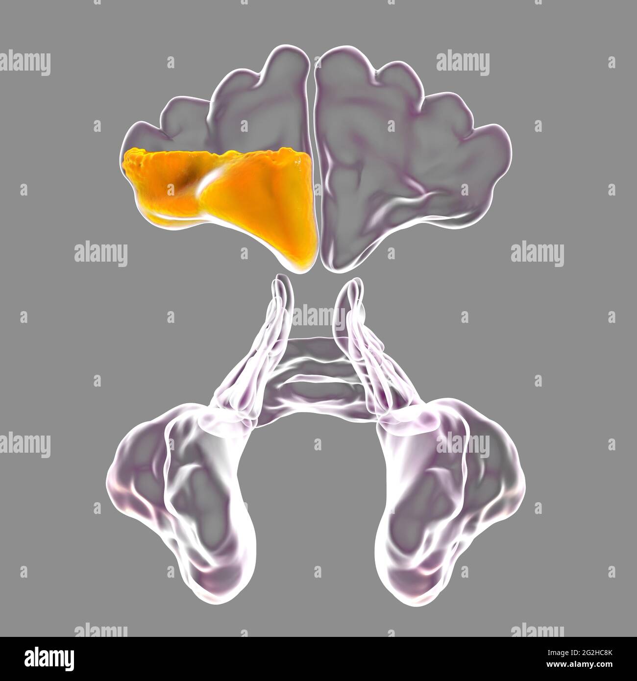 Sinusitis, Abbildung Stockfoto