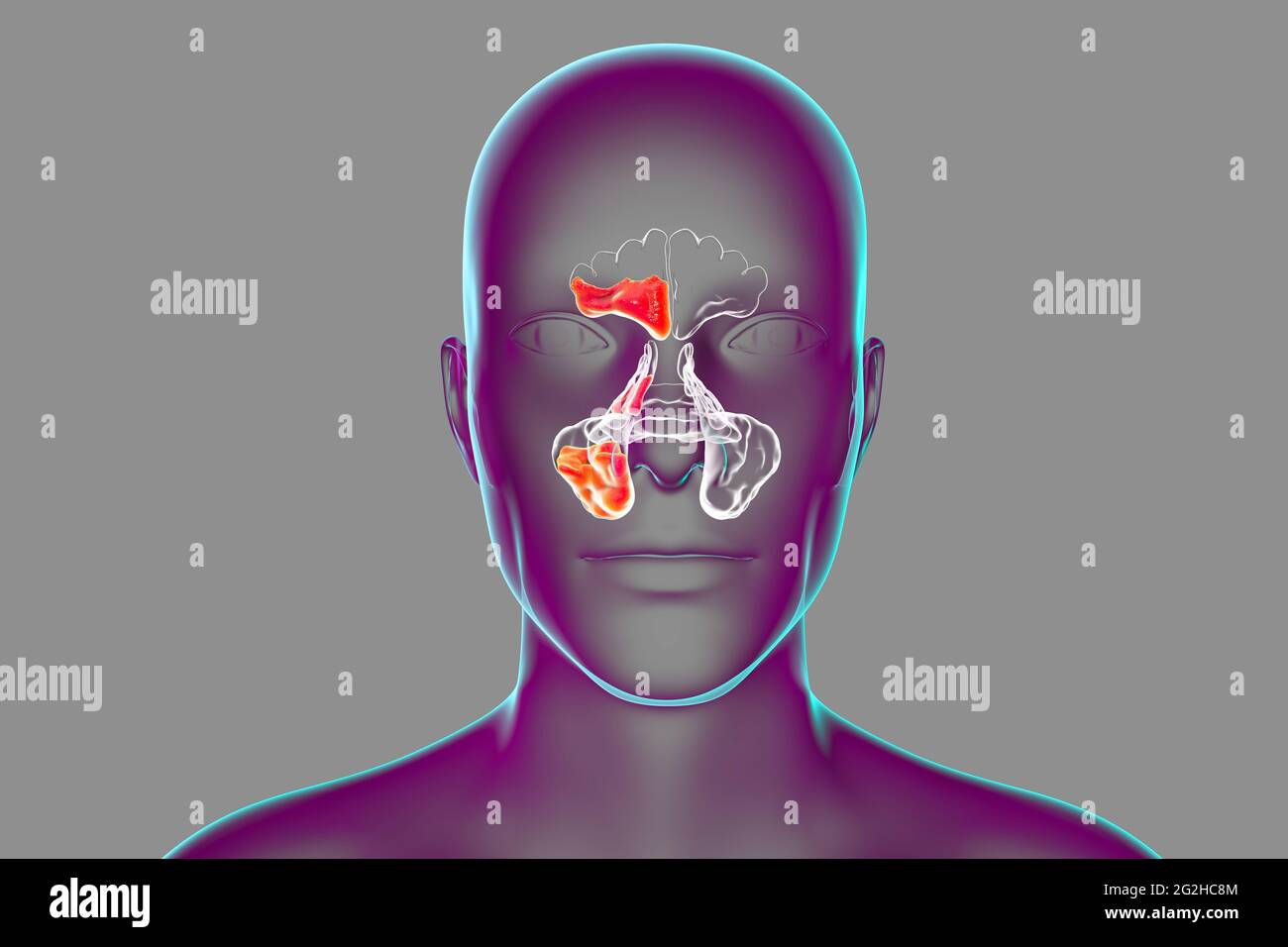 Sinusitis, Abbildung Stockfoto
