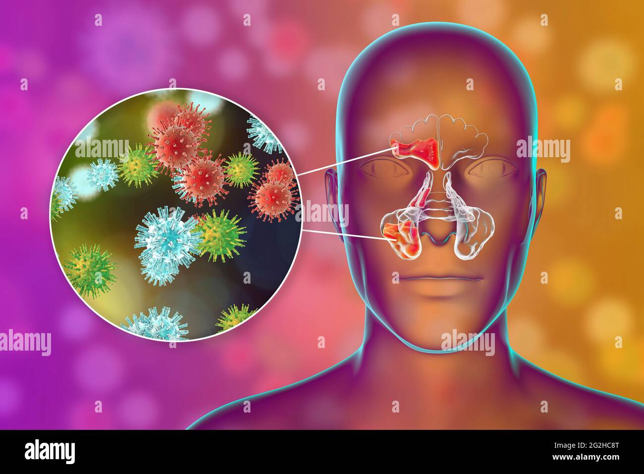 Sinusitis, Abbildung Stockfoto
