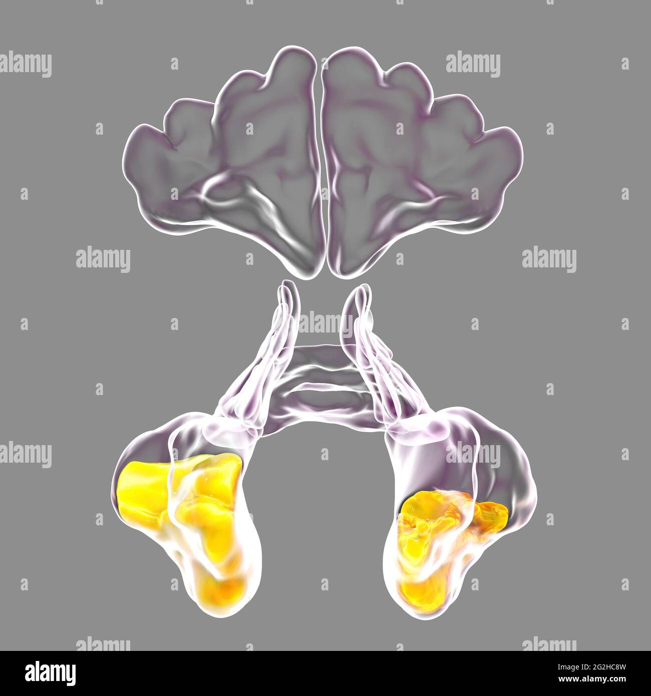 Sinusitis, Abbildung Stockfoto