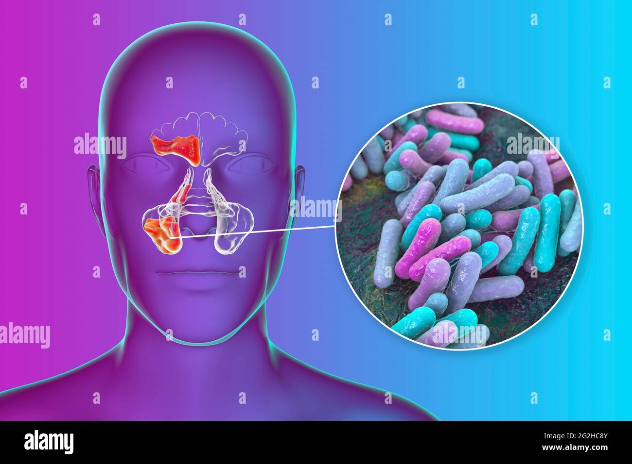 Sinusitis, Abbildung Stockfoto