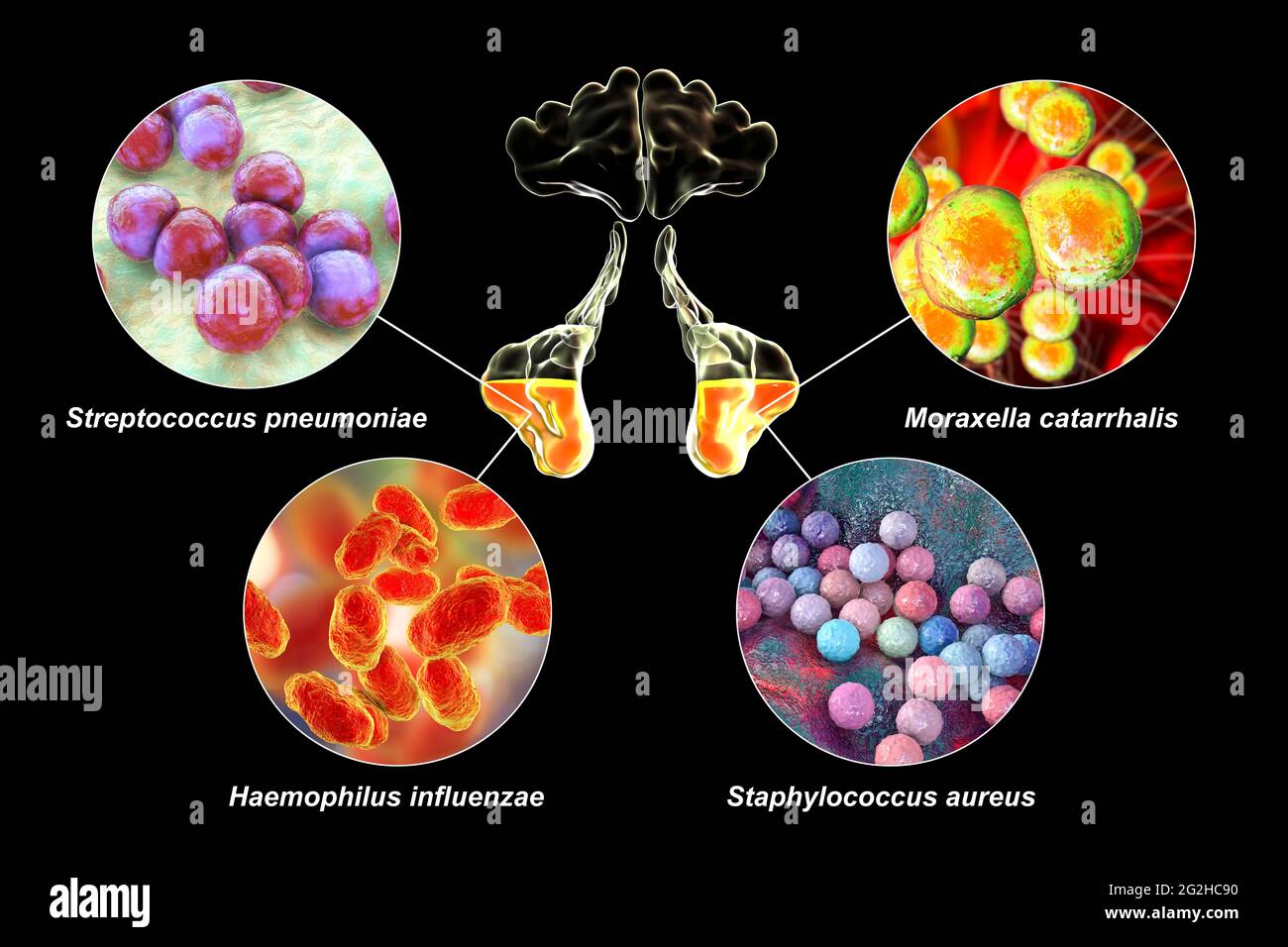 Sinusitis, Abbildung Stockfoto