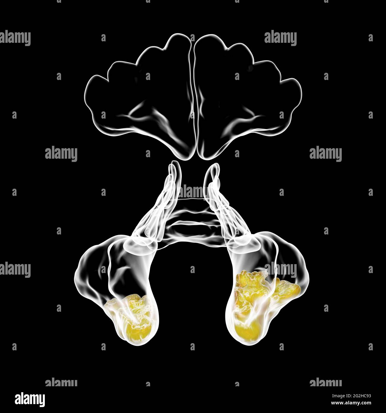 Sinusitis, Abbildung Stockfoto