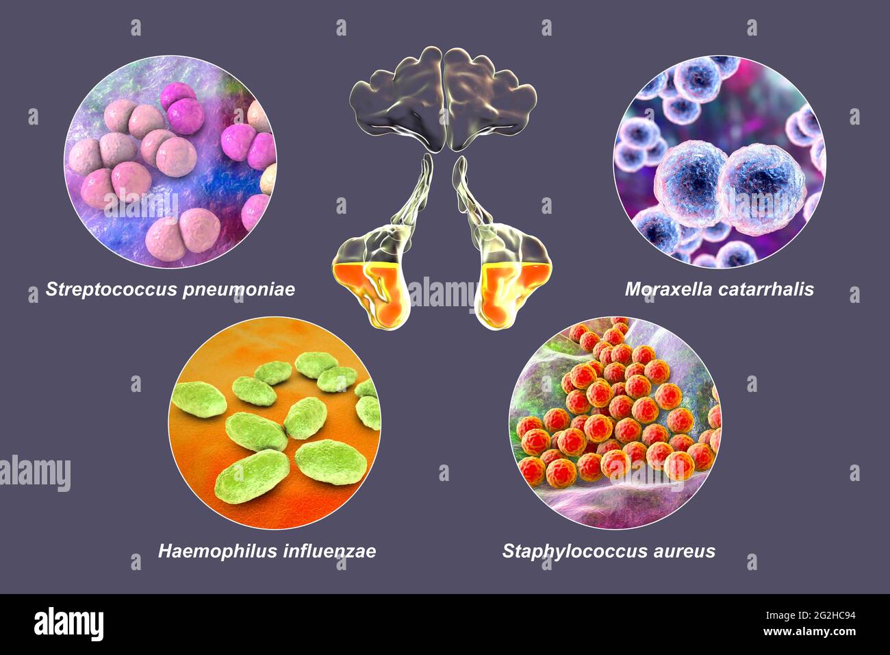 Sinusitis, Abbildung Stockfoto