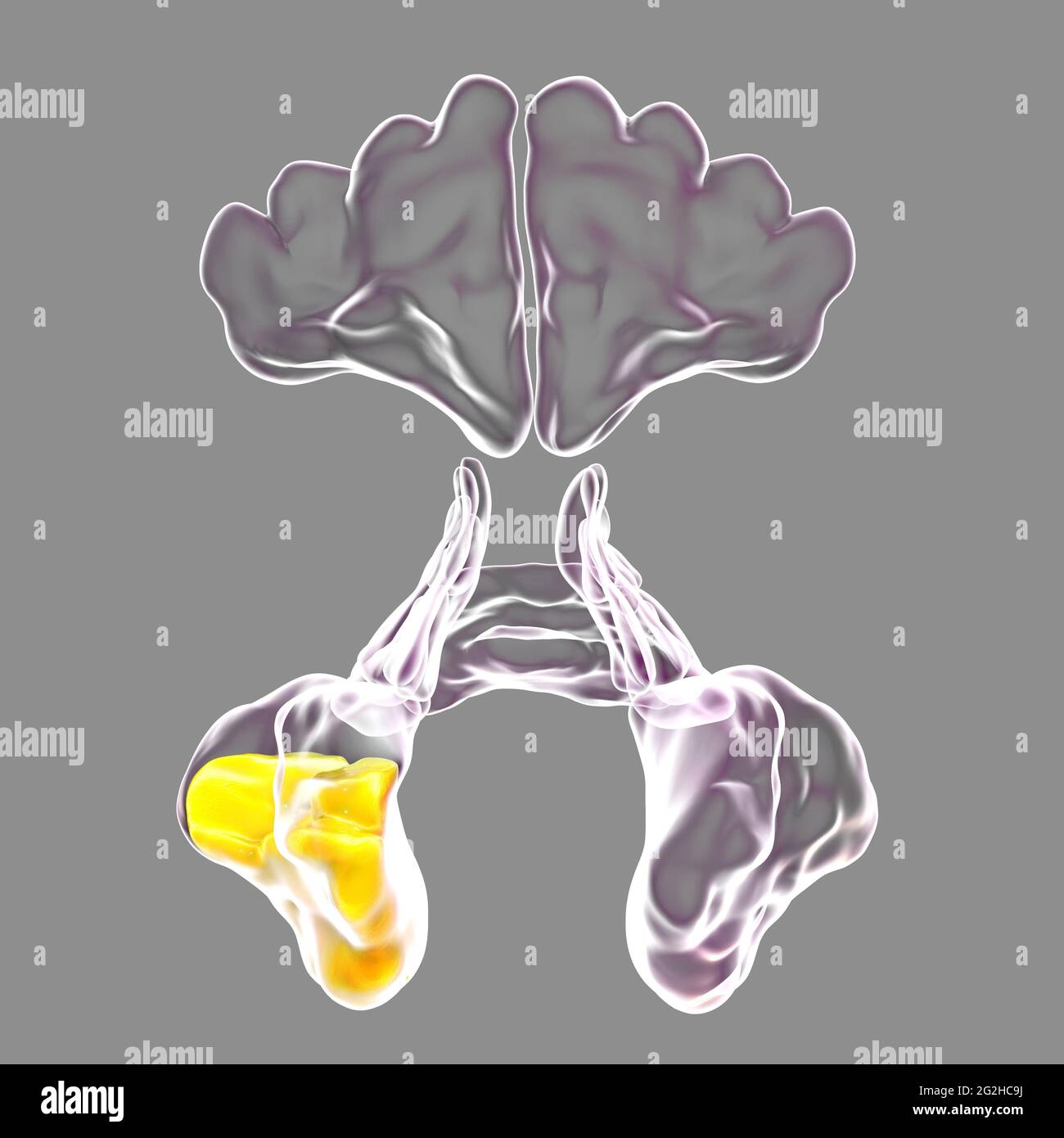 Sinusitis, Abbildung Stockfoto