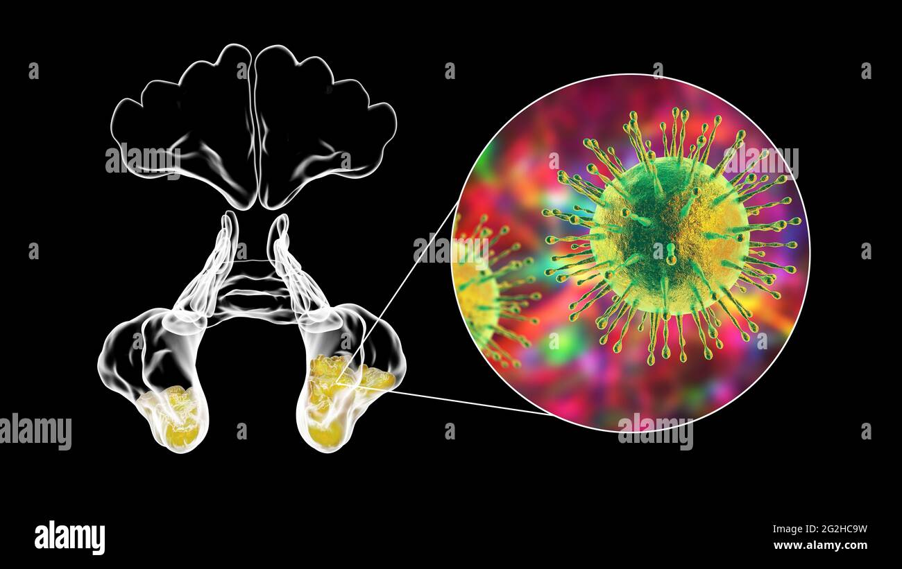 Sinusitis, Abbildung Stockfoto