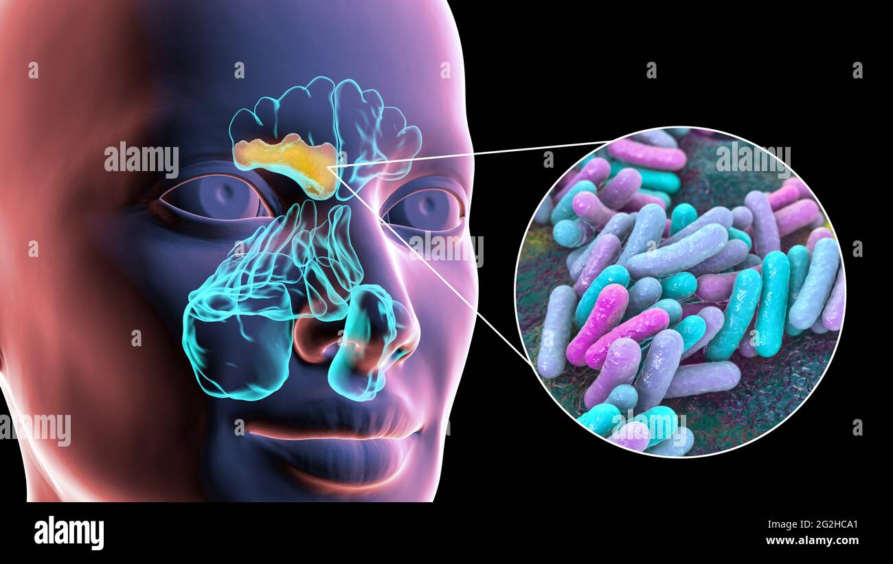 Sinusitis, Abbildung Stockfoto