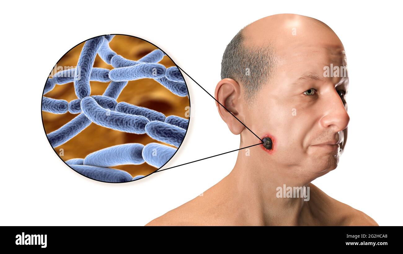 Hautanthrax, Abbildung Stockfoto