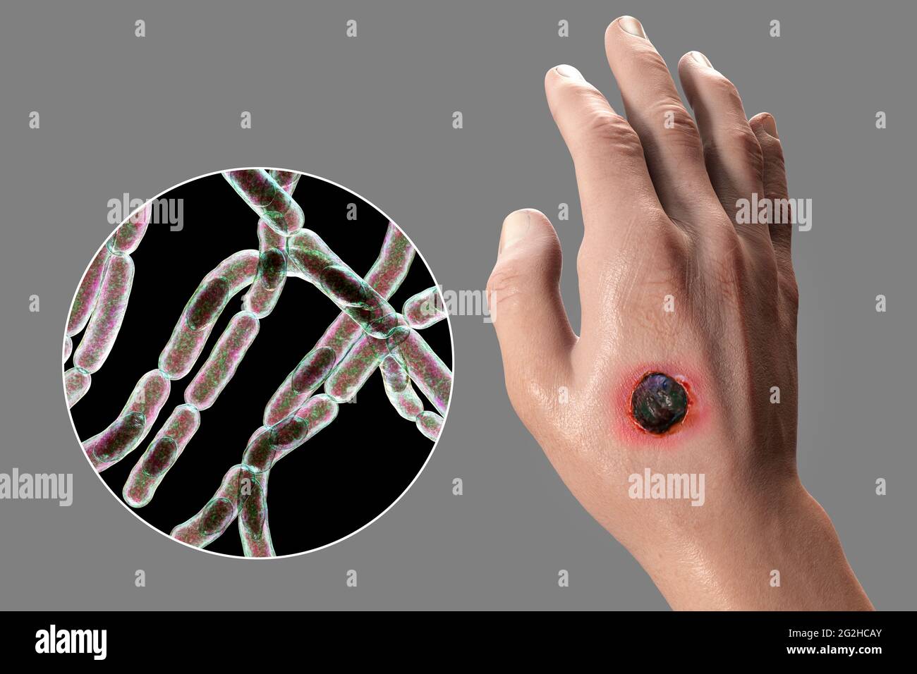 Hautanthrax, Abbildung Stockfoto