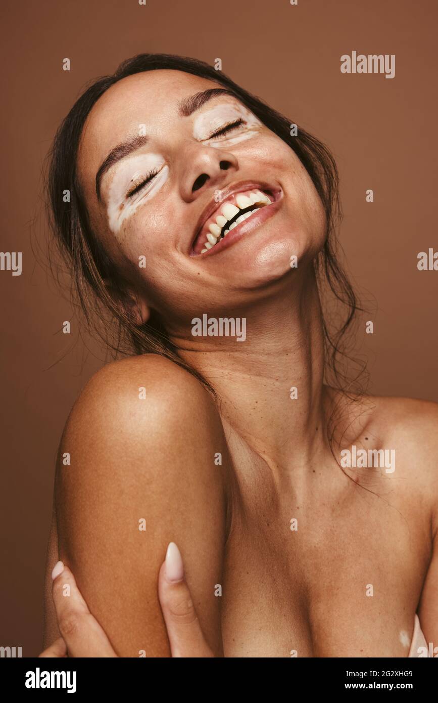 Porträt von glücklichen jungen Frauen mit Vitiligo. Nahaufnahme einer lächelnden Frau mit geschlossenen Augen auf braunem Hintergrund. Stockfoto