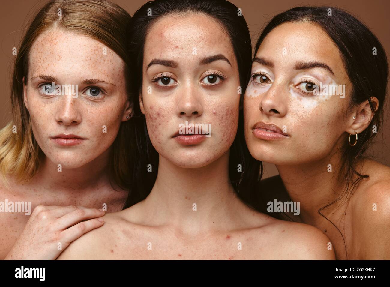 Nahaufnahme von drei starken Frauen, die zusammen Hautprobleme auf braunem Hintergrund haben. Junge Frauen mit verschiedenen Hautkrankheiten wie Sommersprossen, Akne und vi Stockfoto