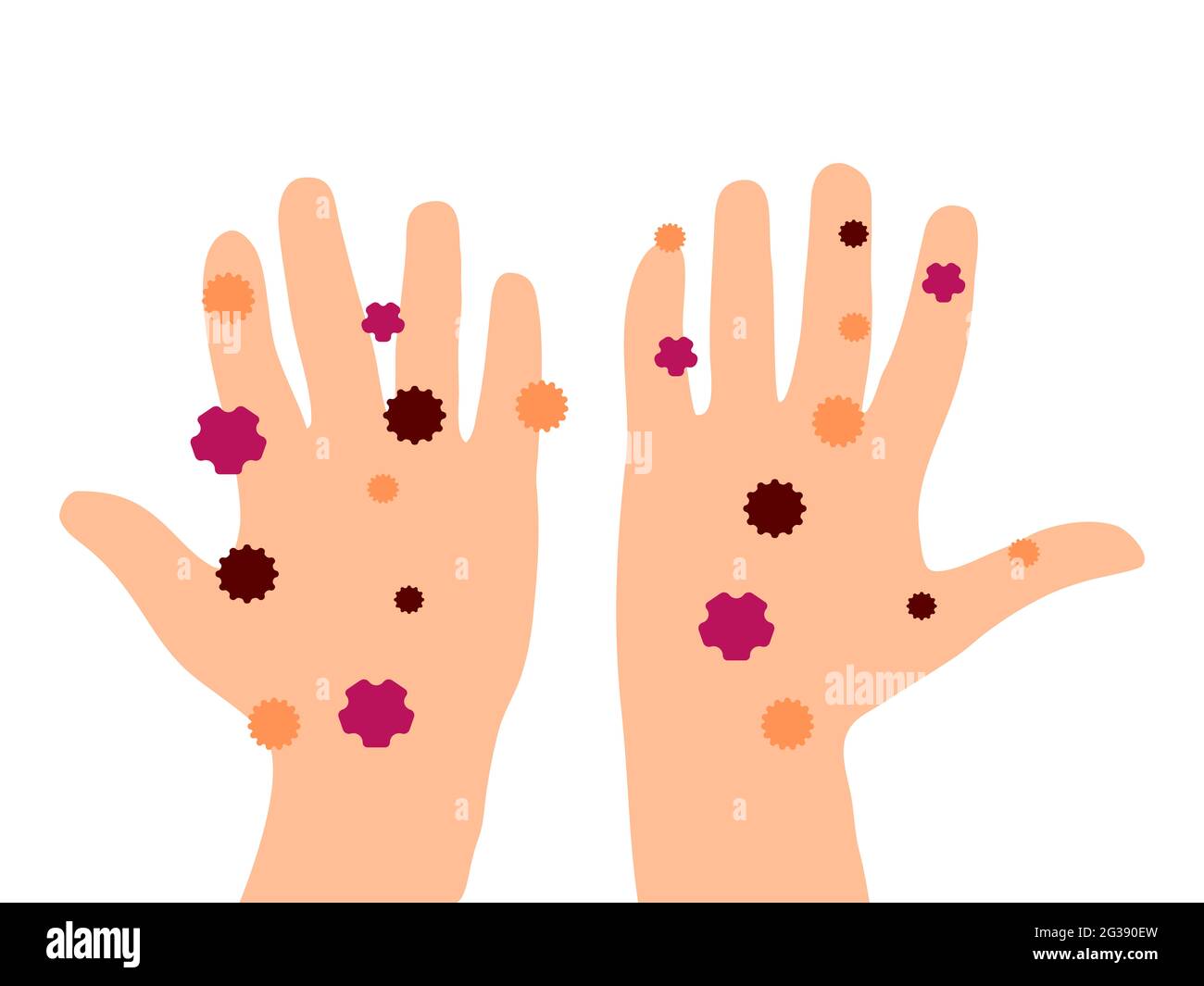 Abbildung: Schmutzige Hände. Hände Handflächen voll mit Bakterien und Viren. Cuacasian weiße Ethnie. Hygienebewusstsein. Stockfoto