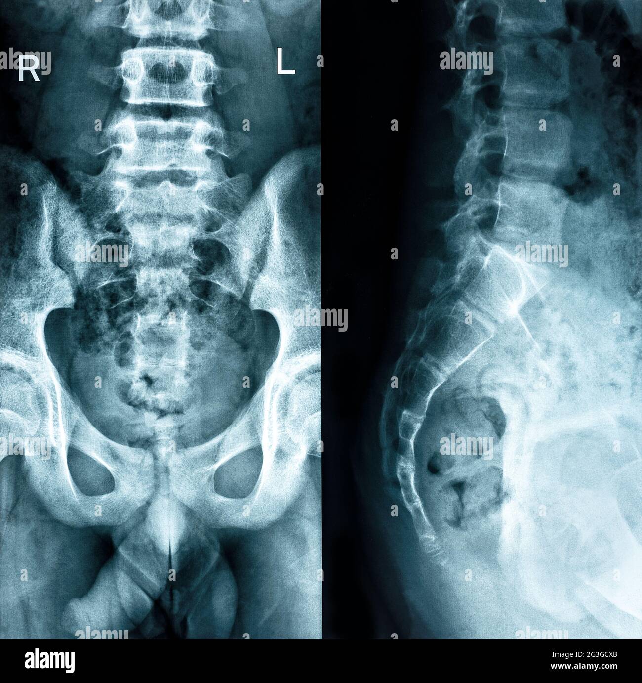 Beckenknochen zwei Positionen prüfen den schwarzen Hintergrund des Roentgenogramms Stockfoto
