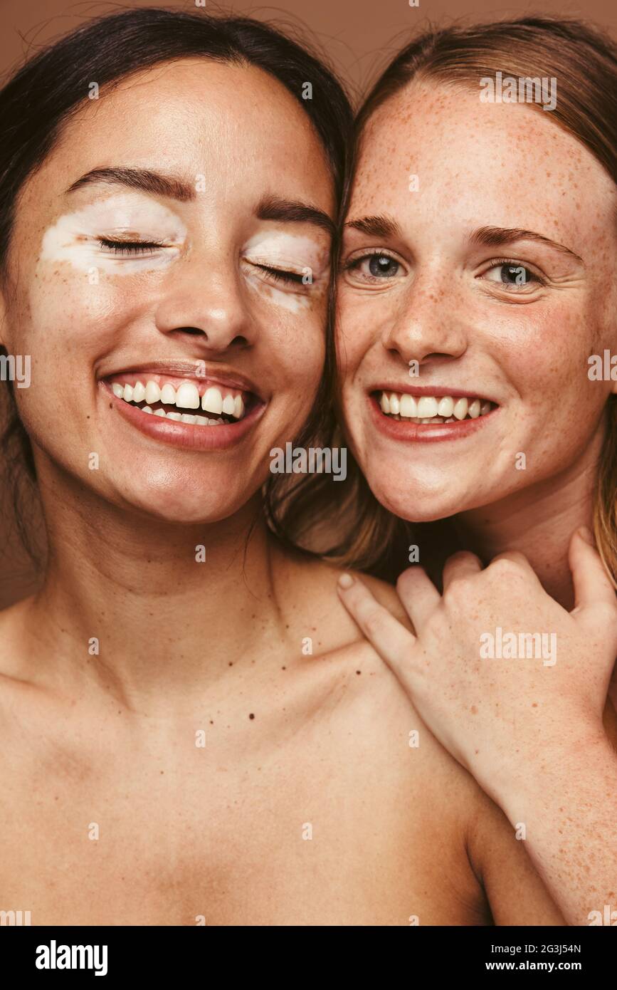 Nahaufnahme von zwei lächelnden Frauen mit unterschiedlicher Haut. Porträt von Frauen mit Vitiligo und Sommersprossen. Stockfoto