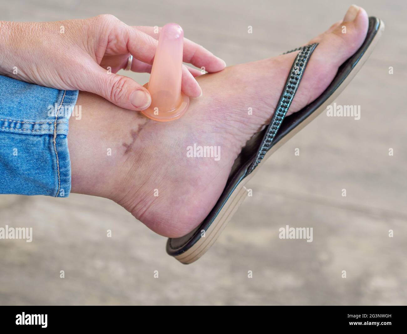 Narbengewebsmassage der kaukasischen Frau, die an gebrochenem Knöchel leidet. Verbesserung der Bewegungsreichweite durch Schröpfen. Stockfoto