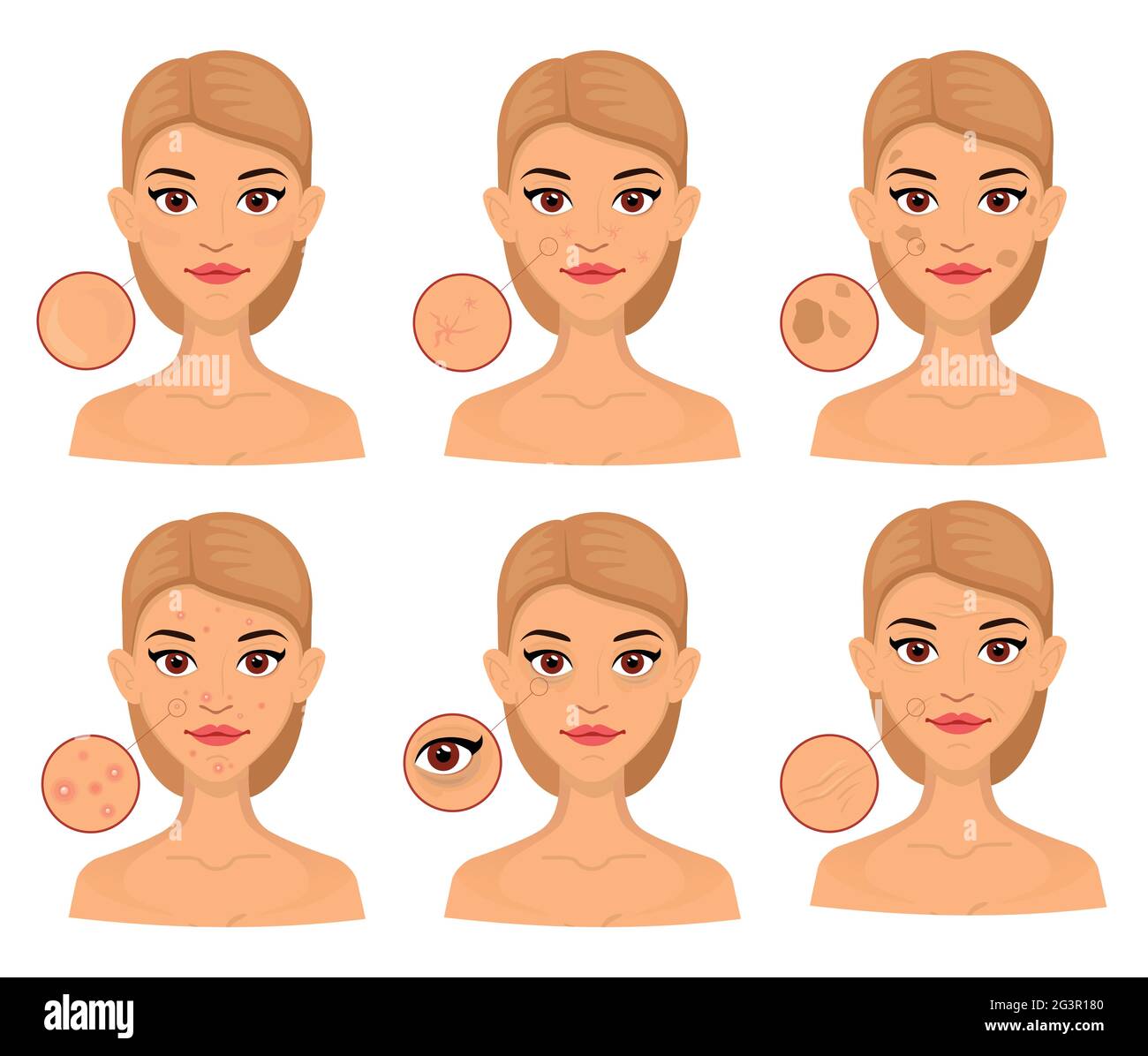Seth Frau verschiedene Arten von Problemhaut, vergrößerte Fläche für die Kosmetologie. Akne, Falten und Altersflecken. Stock Vektor