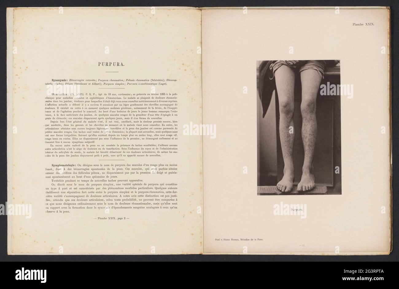 Patient, der an der „Purpura“-Hauterkrankung leidet; Purpura. . Stockfoto