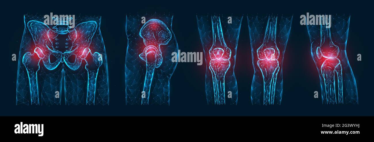 Polygonale Vektordarstellung von Schmerzen oder Entzündungen der Knochen im Becken, Hüftgelenk und Kniegelenken isoliert auf einem dunklen Stockfoto