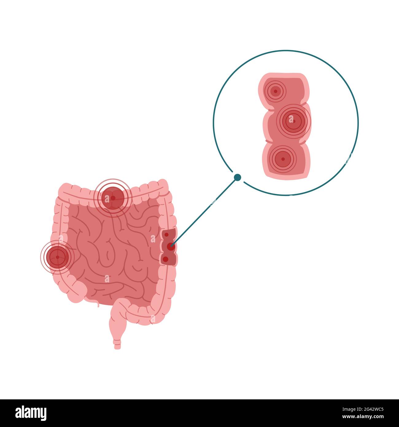 Vektor-Illustration für entzündliche Darmerkrankungen isoliert auf weißem Hintergrund Stockfoto