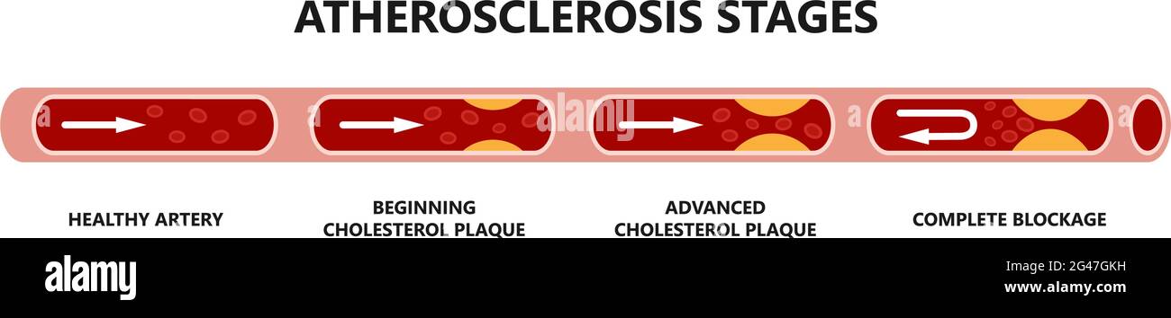 Stadien der Atherosklerose. Gesunde Arterie, beginnende Cholesterinplaque, fortgeschrittener Cholesterinplaque, vollständige Blockade. Stock Vektor