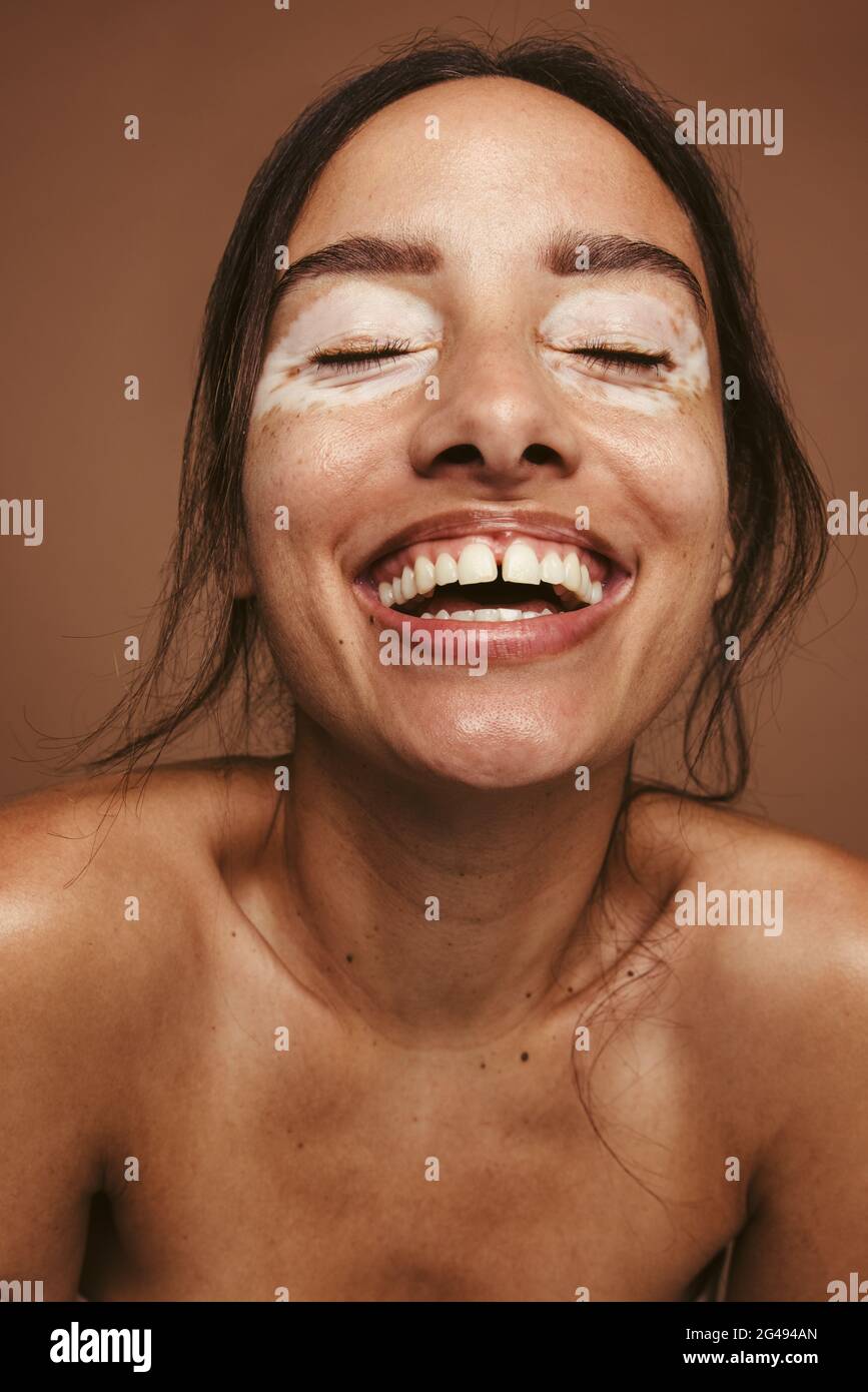 Die junge Frau scheint glücklich zu sein, obwohl ihr Hautzustand eine positive Einstellung des Körpers darstellt. Nahaufnahme Porträt einer lächelnden Frau mit Vitiligo. Stockfoto