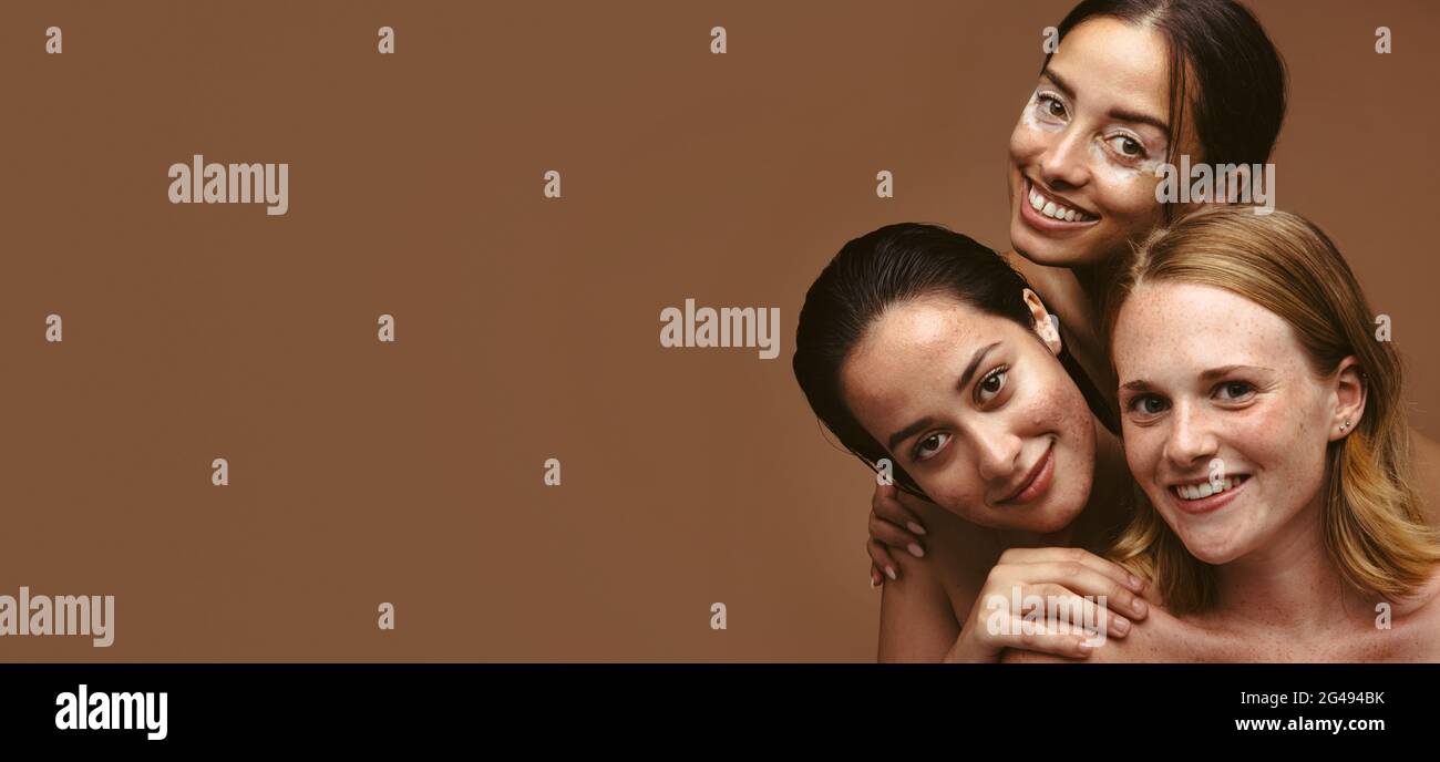 Weitwinkelaufnahme von drei Frauen mit Hautproblemen auf braunem Hintergrund. Frauen mit Hautproblemen sehen mit ihrer natürlichen Haut glücklich aus. Stockfoto