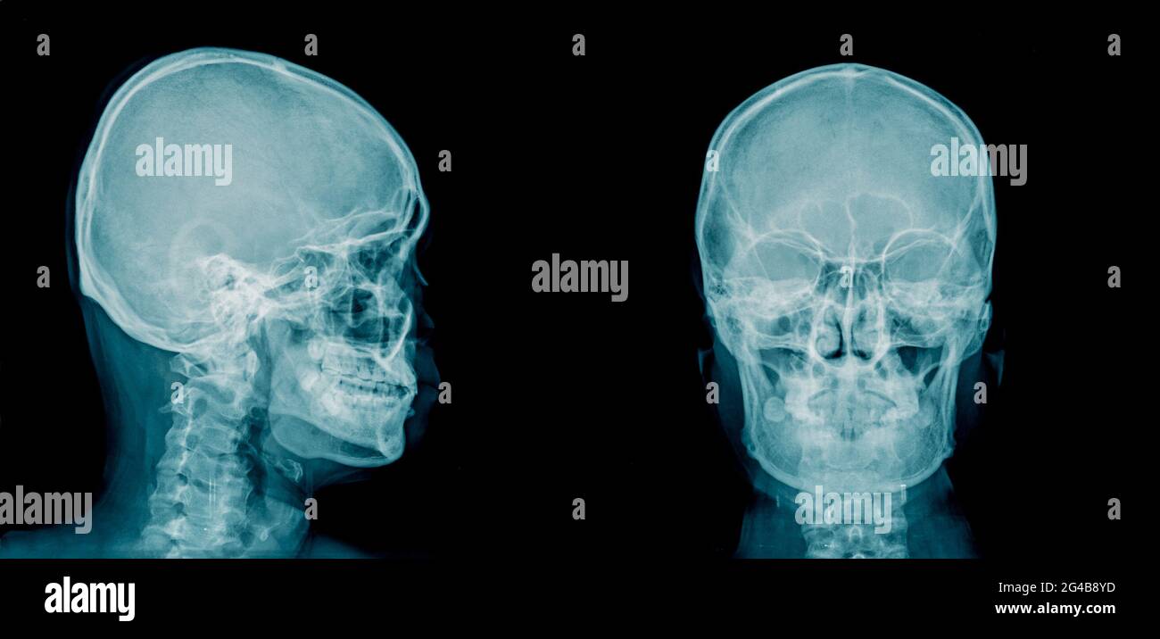 Röntgenbild des menschlichen Schädels AP und laterale Ansicht in blauem Ton Stockfoto