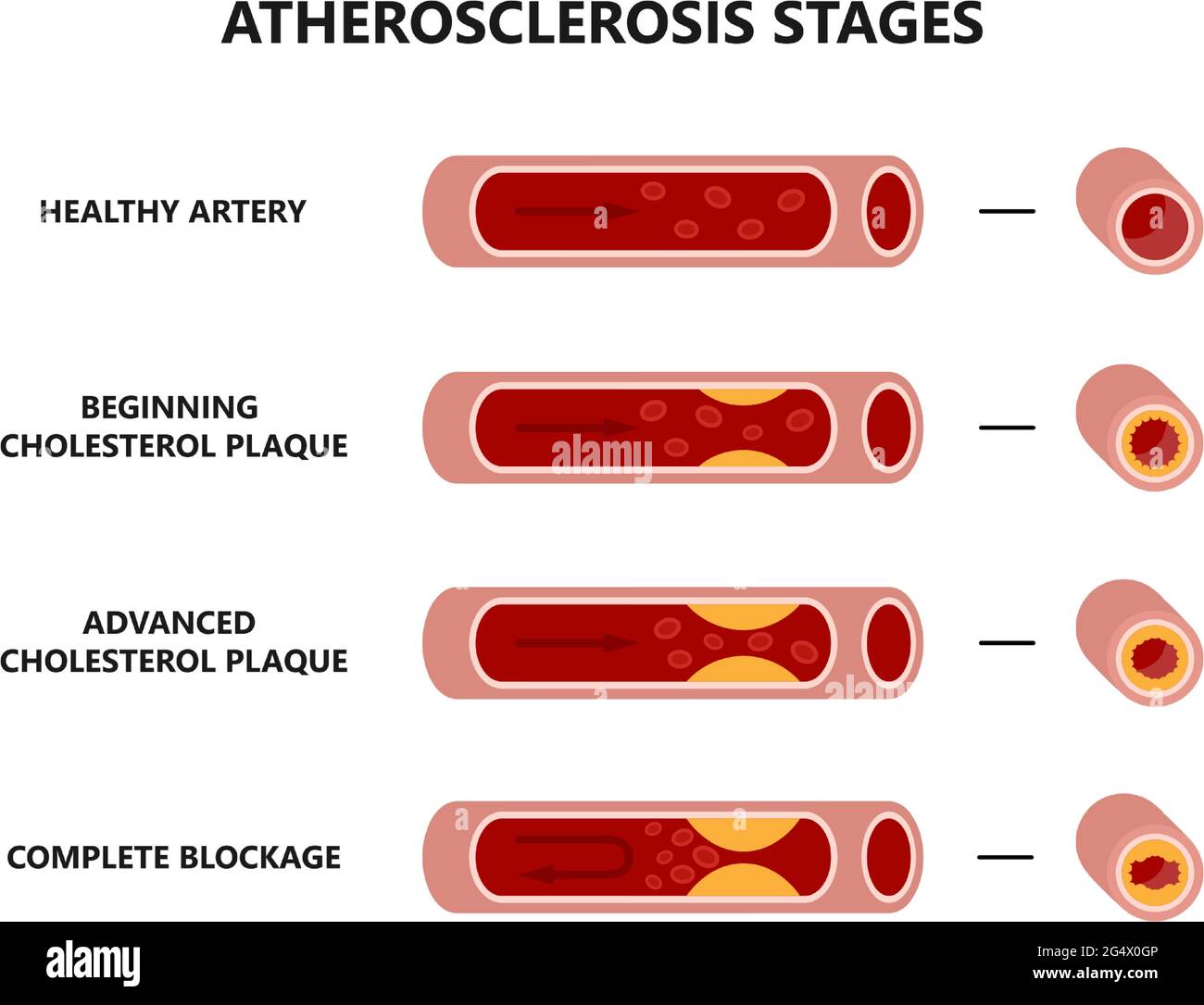 Atherosklerose-Bildung. Gesunde und ungesunde Arterien. Cholesterinplaque in den Blutgefäßen. Stock Vektor