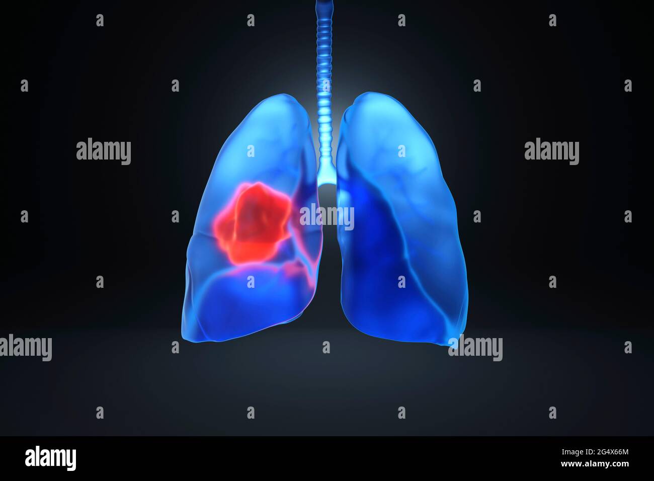 Digital generiertes Bild von krebskranken Lungen Stockfoto