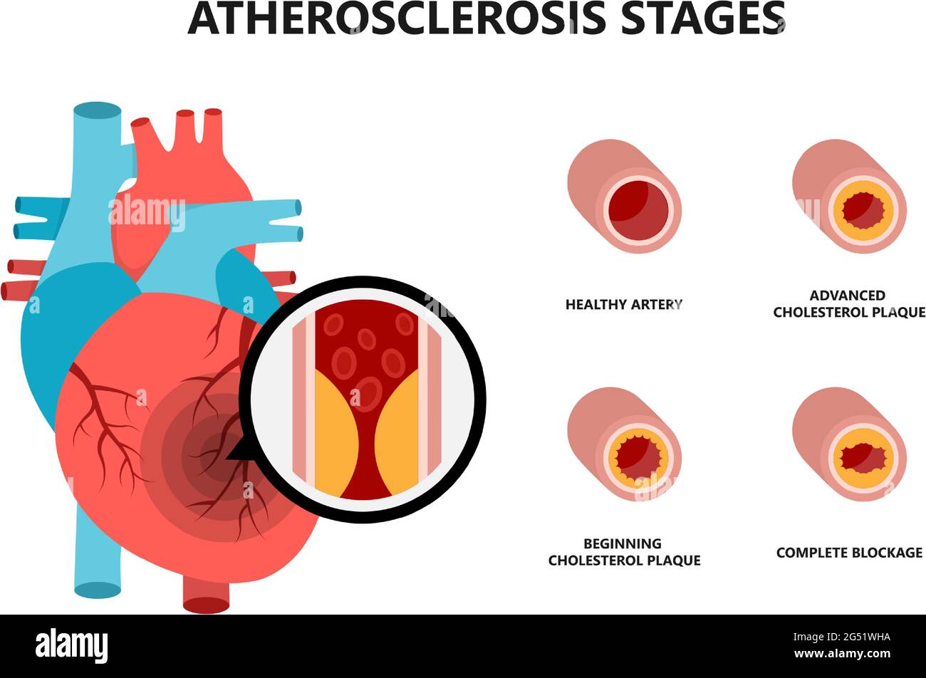 Anatomie des menschlichen Herzens mit atherosklerotischer Plaque. Cholesterinplaque in den Blutgefäßen. Stock Vektor