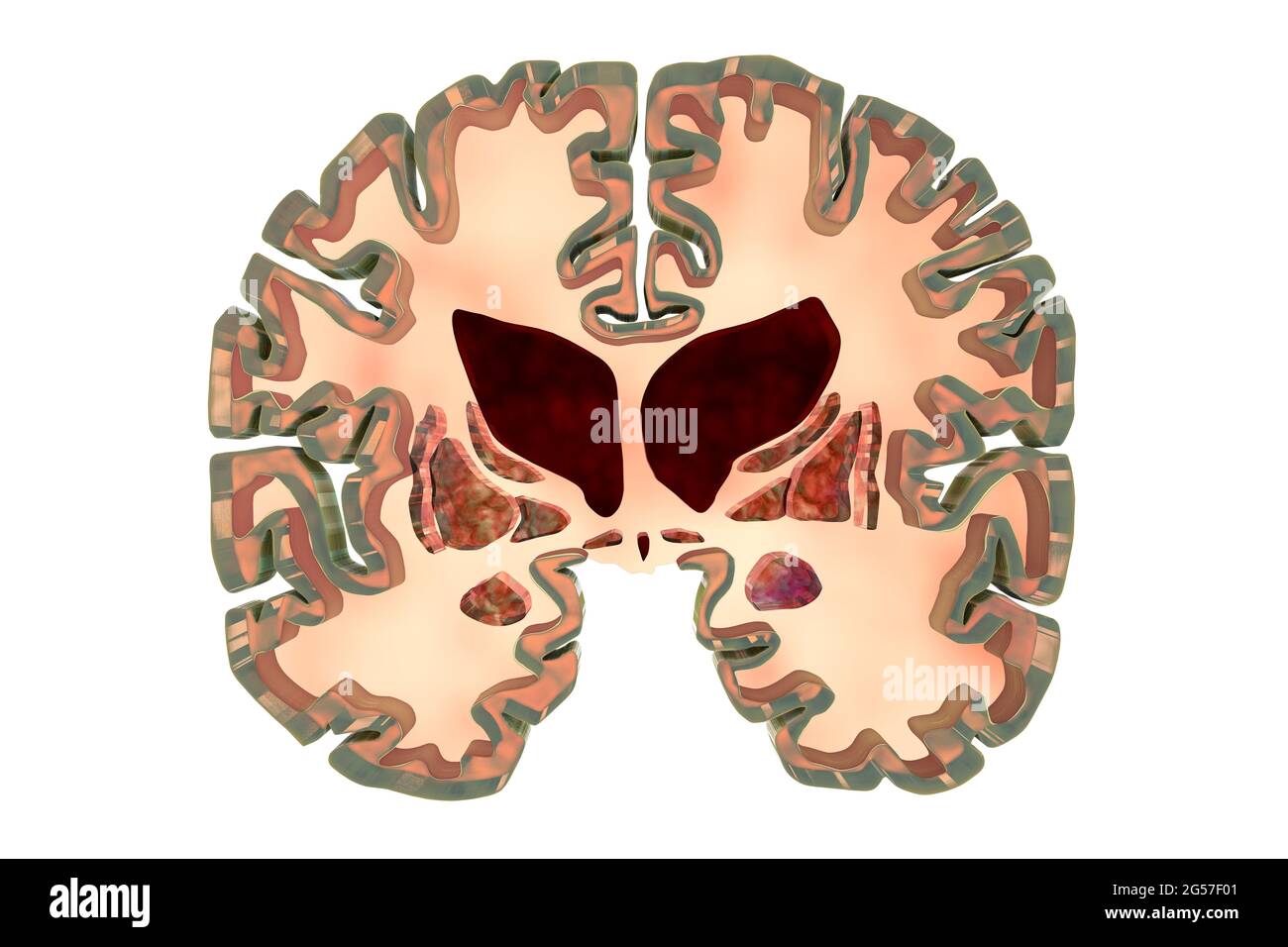 Gehirn bei der Huntington-Krankheit, Illustration Stockfoto