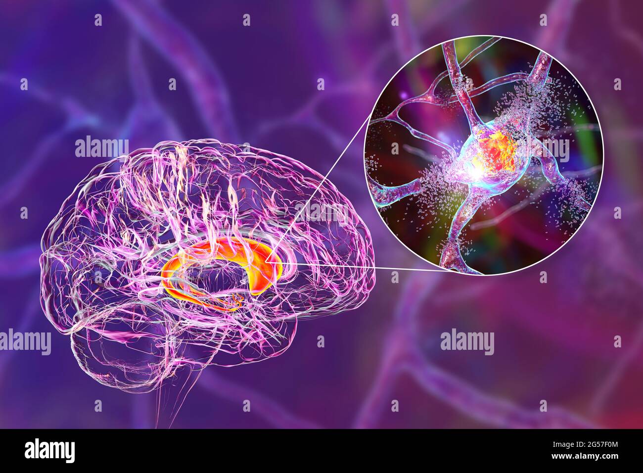 Zerstörung von Neuronen des Kautzellkerns, Illustration Stockfoto