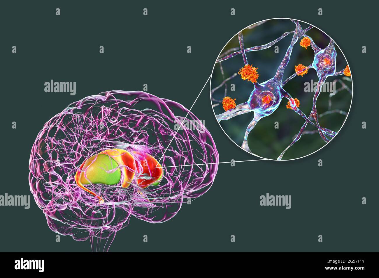 Dorsale Striatum bei der Huntington-Krankheit, Illustration Stockfoto