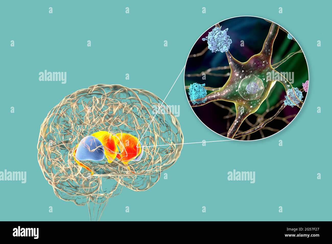 Dorsale Striatum bei der Huntington-Krankheit, Illustration Stockfoto