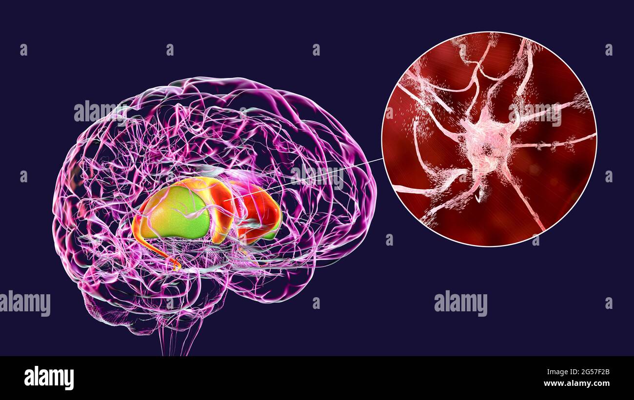Dorsale Striatum bei der Huntington-Krankheit, Illustration Stockfoto
