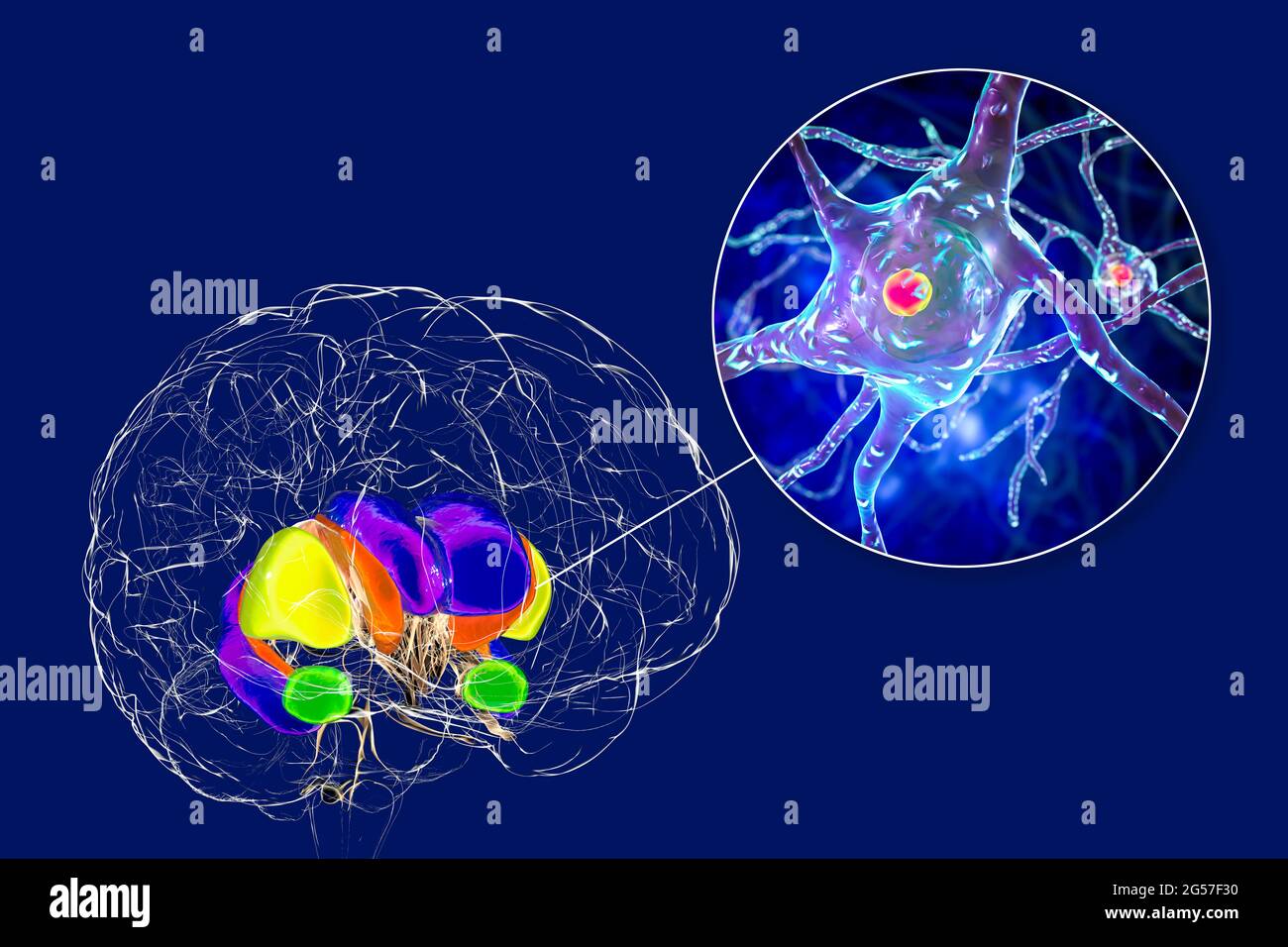 Dorsale Striatum bei der Huntington-Krankheit, Illustration Stockfoto