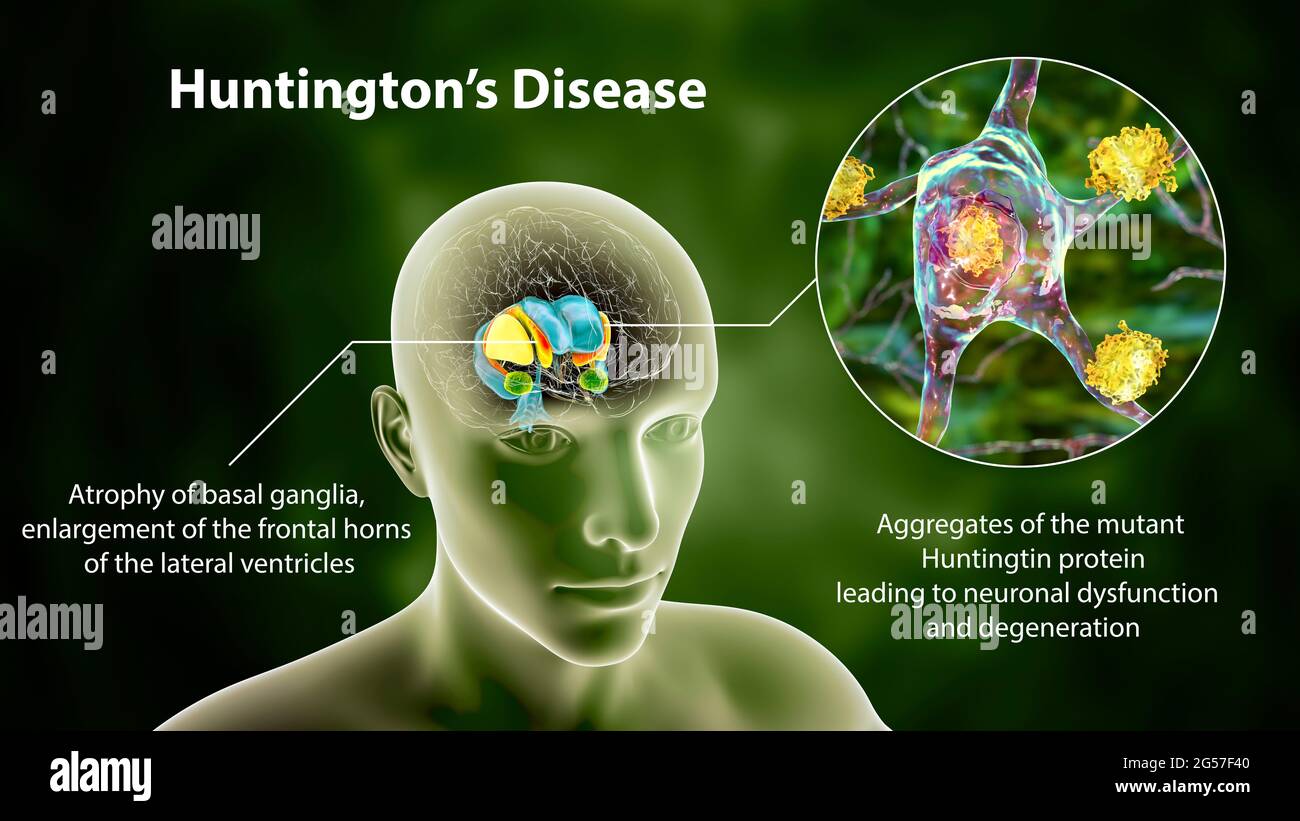 Was Ist Die Huntington Krankheit www.alamy.de